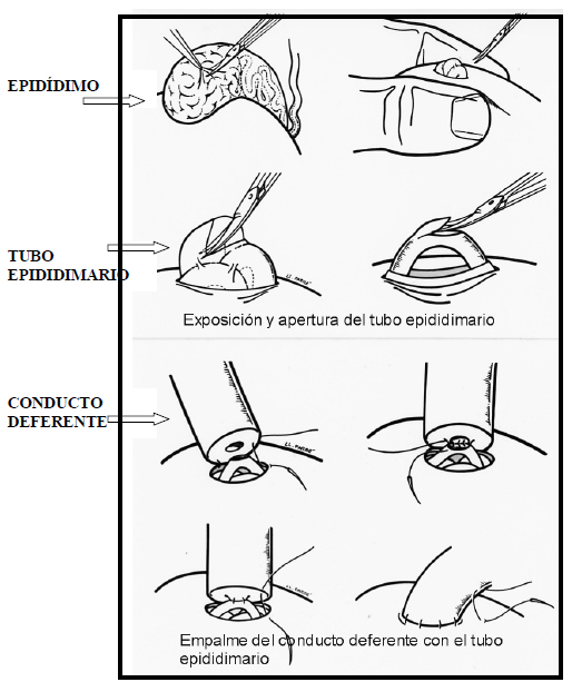 Epididimovasostomía